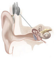 250px-Cochlear_implant.jpg